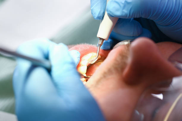 Best Emergency Dentist for Lost Fillings or Crowns in Somerville, TX