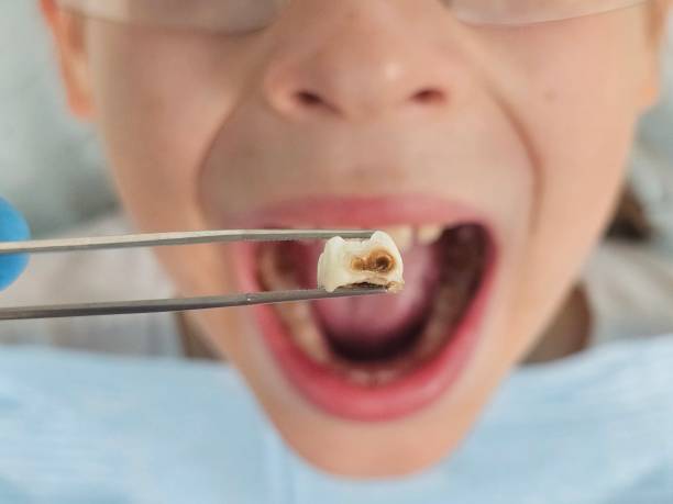 Best Emergency Dentist for Knocked-Out Tooth in Somerville, TX